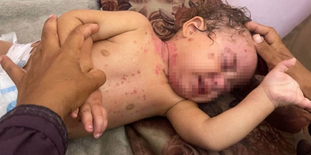 Gazze'de cilt hastalıklarında artış!