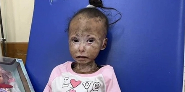 Gazzeli kız çocuğu, hastalık ve açlıkla hayatta kalma savaşı veriyor