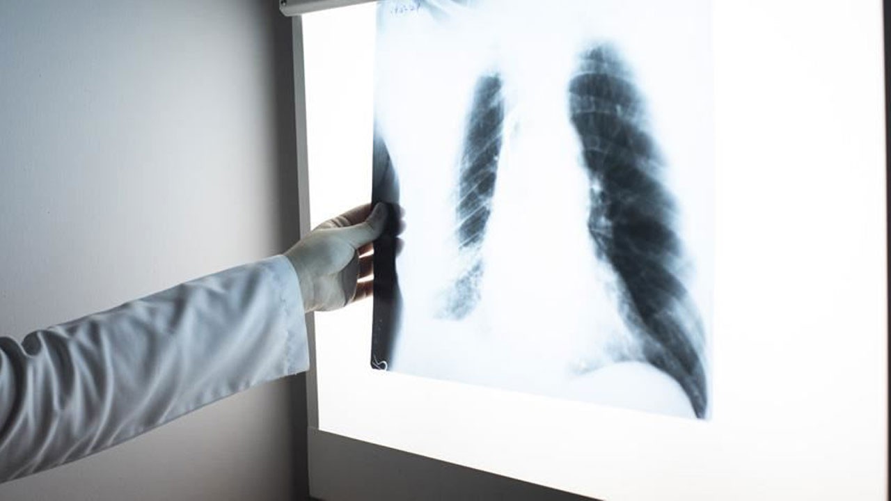 Geç fark edildiğinde ölümcül oluyor! Dünyada her yıl 2 milyon ölüm