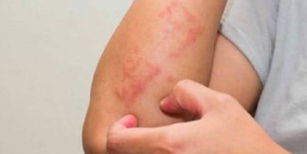 Geceleri uyutmayan kaşıntıya dikkat! Sebebi 'uyuz' olabilir! Uyuz hastalığına ne iyi gelir?