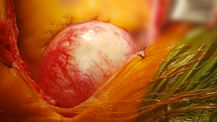 Gelmiş geçmiş en nadir olay! Aort damarı normalden 3 kat fazla büyüdü