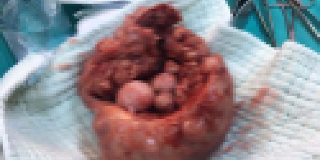 Genç kadının rahminden çıkarıldı