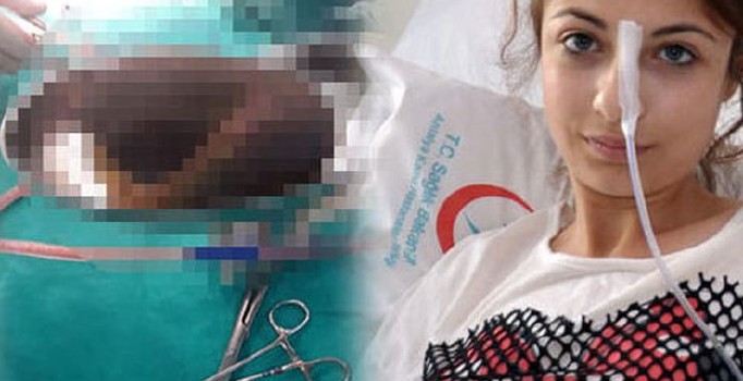 Genç kızın midesinden 1.5 kilo saç yumağı çıktı
