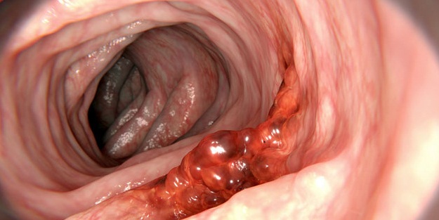 Gençler, bağırsak kanserine dikkat!