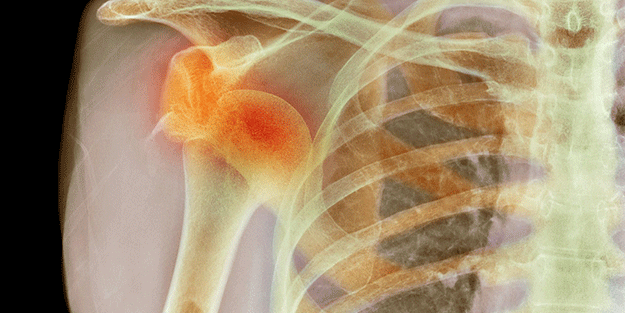 Gençlerde omuz çıkığı daha zor iyileşiyor