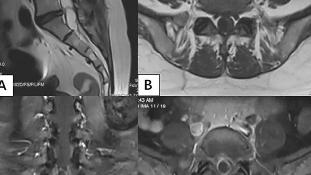 Gerçeği öğrenince inanamadı: Omurgasını adeta istila etmişler! Daha önceden görülen bu belirtilere dikkat!