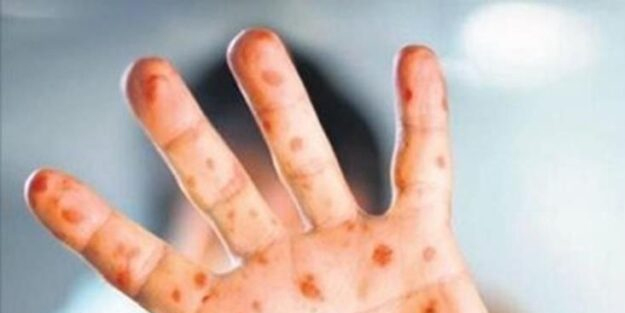 Gerçek vaka ve ölüm sayısı yüksek! DSÖ, 'maymun çiçeği'nden yüzlerce kişinin öldüğü resmen raporlandı!