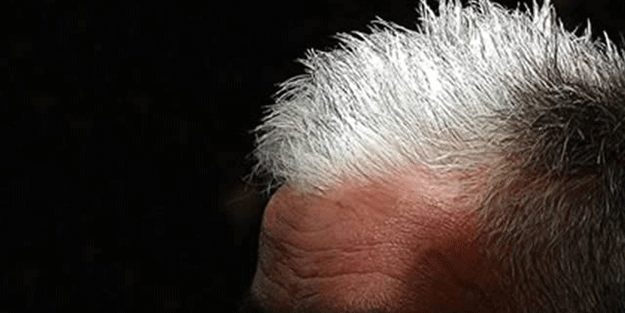 Gerginlik saçlarımızı ağartıyor