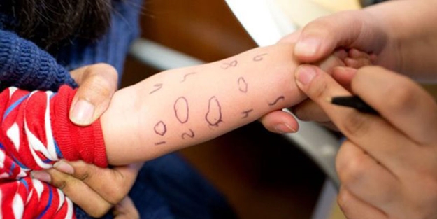 Gıda alerji vakaları neden artıyor?