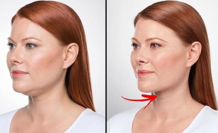 Gıdı sarkmalarını önlemek bu 2 tarifle mümkün!