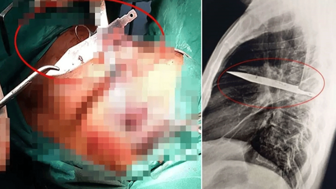 Göğüs ağrısıyla doktora gitti, 8 yıldır göğsünde saplı bıçakla yaşadığı ortaya çıktı