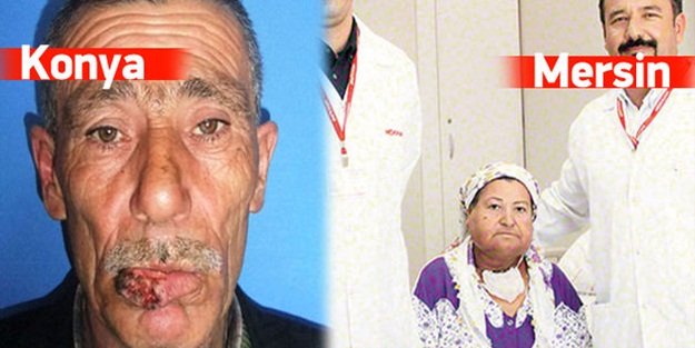 Göğüs dokusundan dudak ve dil yaptılar