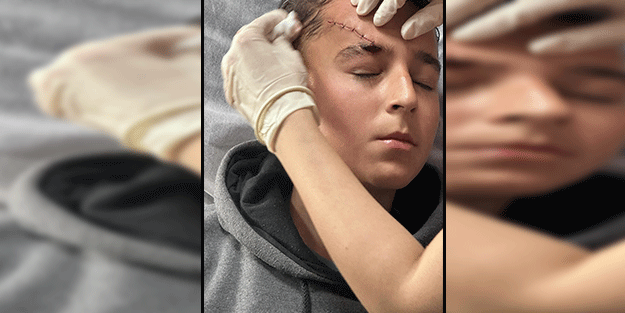 Gölbaşı'nda başıboş köpek saldırısı! 12 yaşındaki çocuk yaralandı