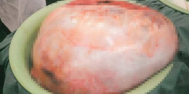 Görenler hamile sandı ama ölüyordu