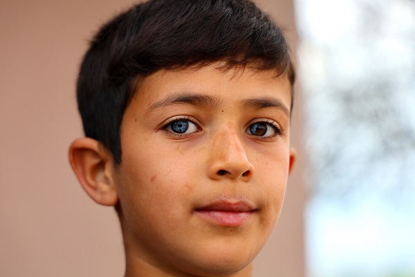 Görenler şaşırıp kalıyor! Bu çocuk dünyaya çift renk bakıyor