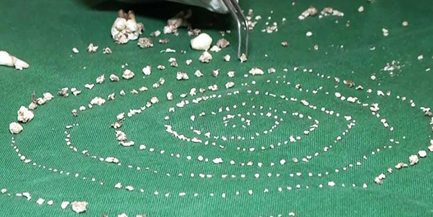 Görülmemiş hastalığa yakalandı! Ağzından 526 diş çıkarıldı