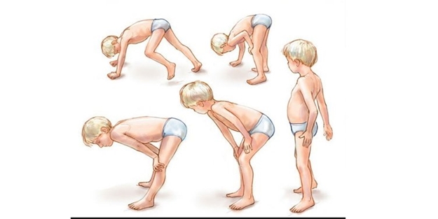 Gowers rahatsızlığı hakkında her şey…