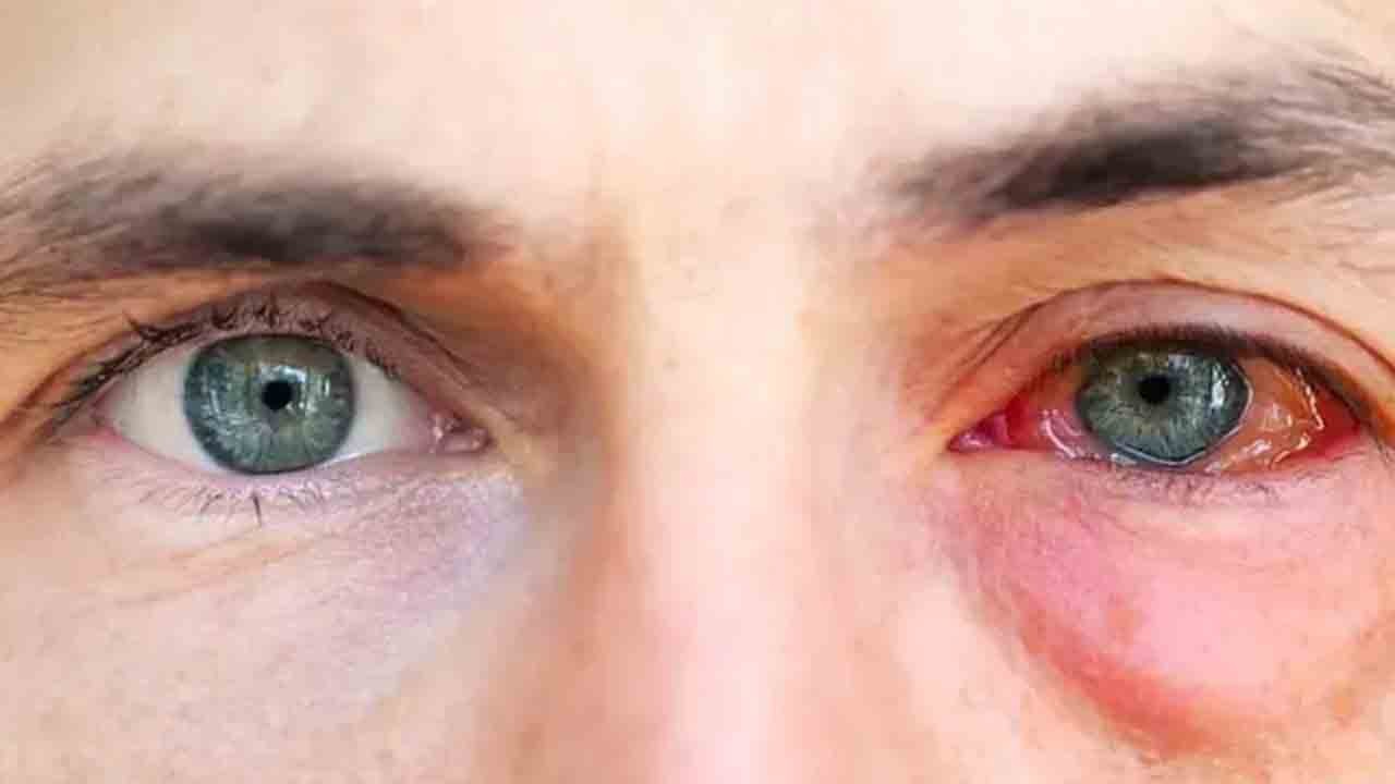 Göz alerjisinden bahar nezlesine… Bahar aylarında gözleri tehdit eden 5 önemli sorun!