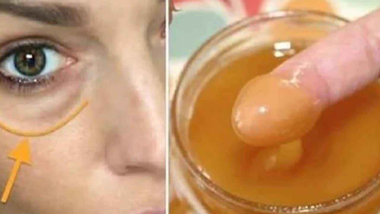 Göz altı morlukları doğal olarak nasıl geçer? Ne iyi gelir? Koruyucu krem: 24 saatte son verilmesi gerekiyor