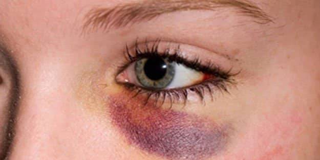 Göz altı morlukları nasıl geçer?