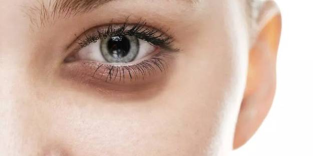 Göz altı morluklarına iyi gelen besinler