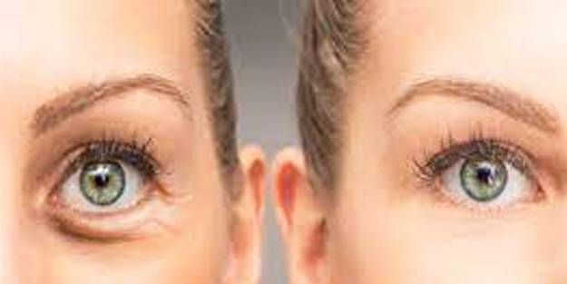 Göz altı şişkinliklerine iyi gelen besinler...