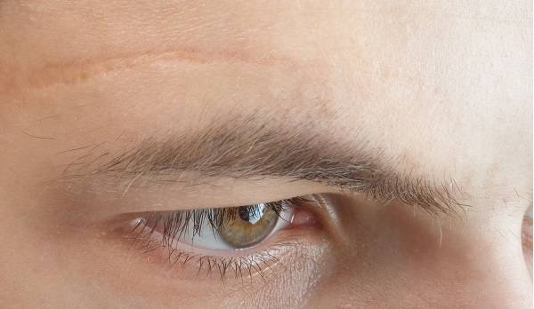 Göz kapağı ameliyatı nasıl yapılır?