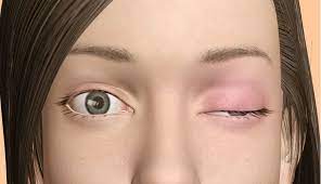 Göz kapağında düşme, çift görme, çiğneme ve yutma zorluğu o hastalığının habercisi olabilir