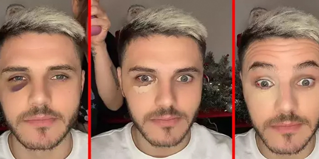 Göz morluğu gündem oldu! Flaş açıklama geldi: İşi şova döktüler! Futbolu unutunca Nara devreye girdi...