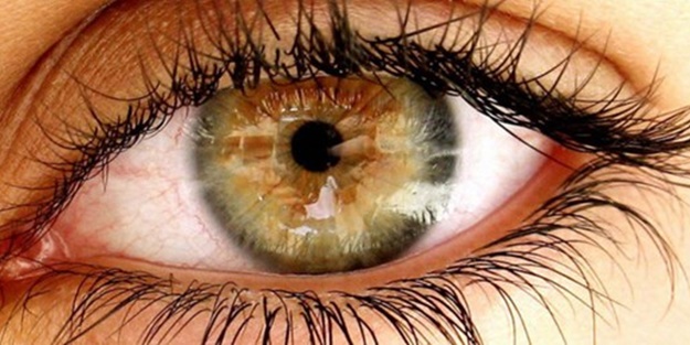 Göz seğirmesinin nedenleri nelerdir?