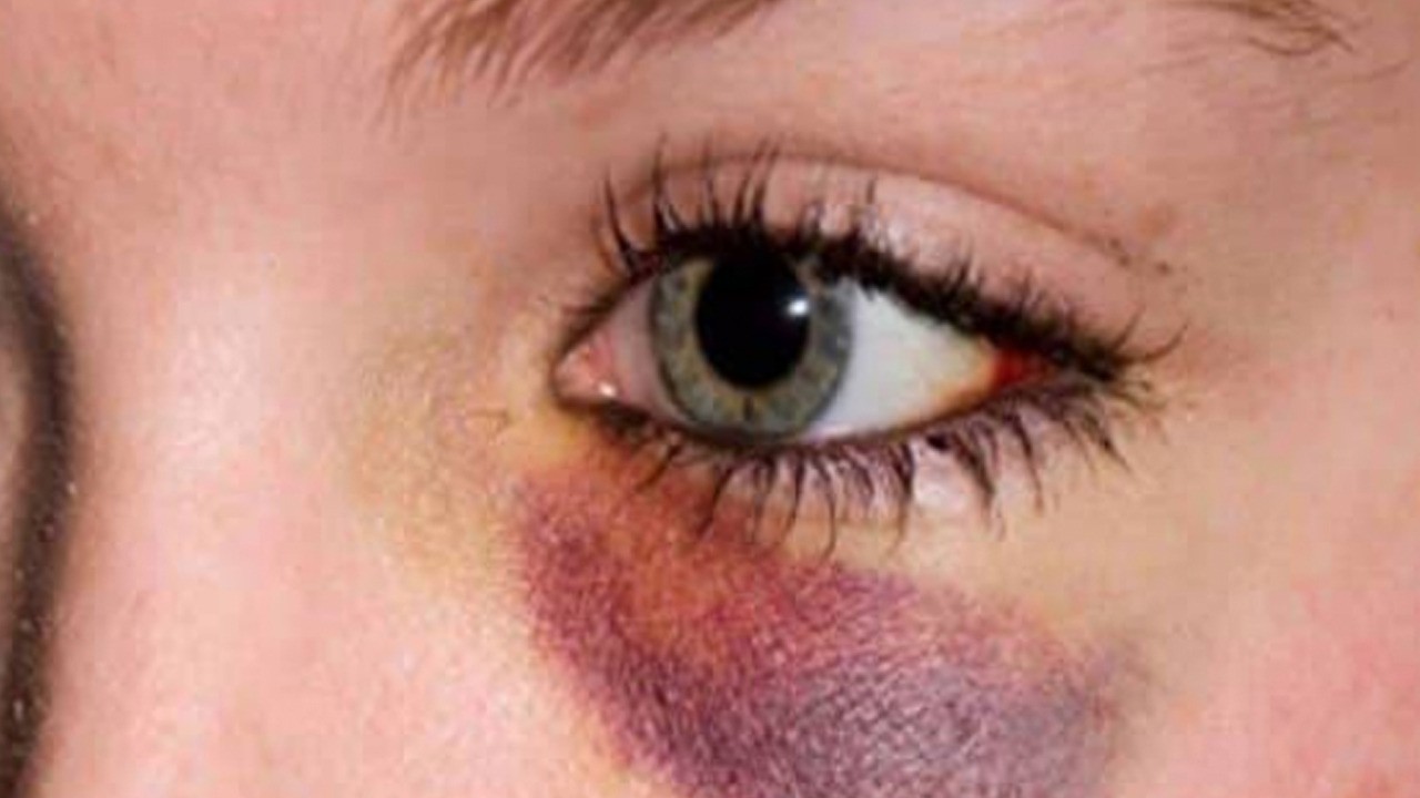 Gözaltı morlukları nasıl geçer? Evde bunları yapın