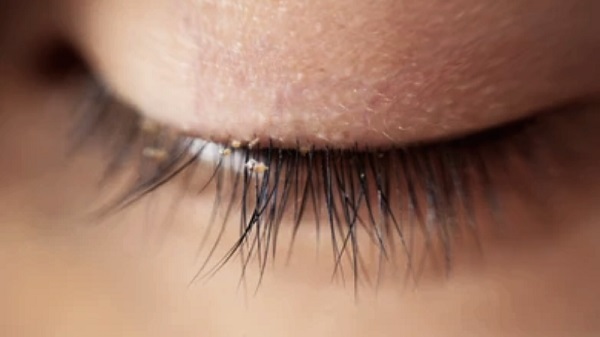 Gözde çapaklanma varsa dikkat!