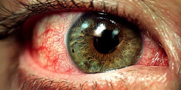 Gözünüz sürekli kızarıyorsa dikkat!