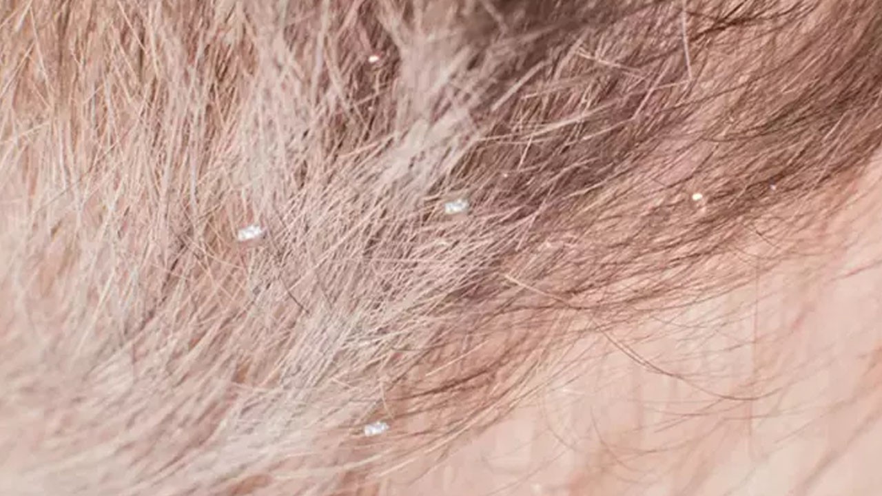 Gri saçları siyaha çeviren asırlık formül! Şimdiden alın suyuna 1 parça ekleyin!