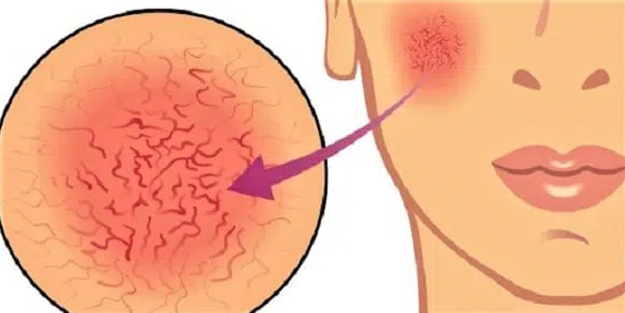 Gül hastalığı (Rosasea) belirtileri, nedenleri ve doğal çözümler! Gül hastalığı bulaşıcı mıdır?