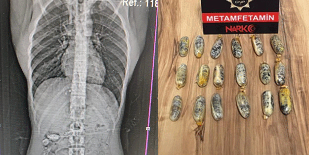 Gümüşhane’de ağızları açık bırakan olay! Midesinden çıkanlar pes dedirtti
