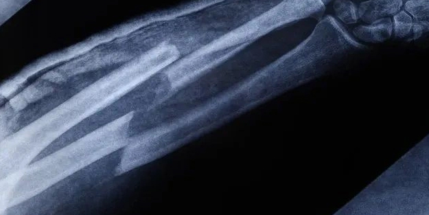 Günde 1 porsiyonu yetiyor: Çelik gibi kemikler için tüketin!