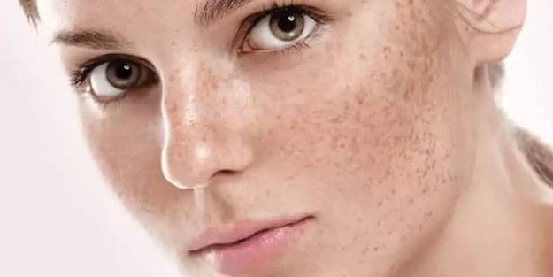 Güneş lekelerinin tedavisi kışın, korunma yazın olmalı