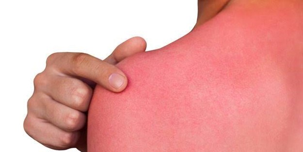 Güneş yanığını tedavi etmenin yöntemleri