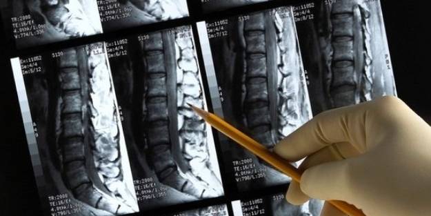 Günlük hayatta yapılan bu hataya dikkat edin! Kemik erimesi sebebi