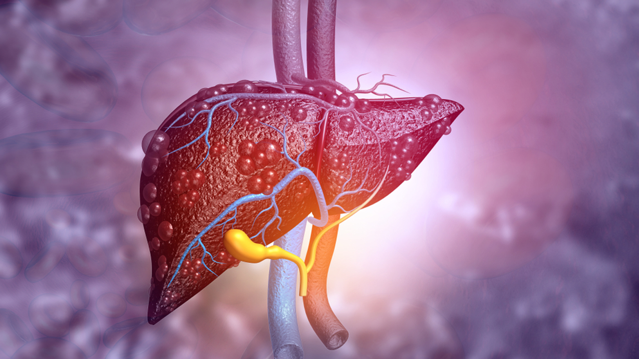 Günümüzün Sinsi Tehlikesi: Karaciğer Yağlanması!