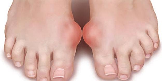 Gut hastalığı belirtileri nelerdir? Gut hastalığına bitkisel çözüm