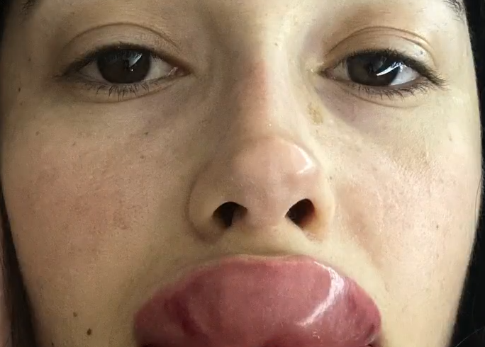 Güzelleşme hayali hüsranla bitti! Sosyal medyanın konuştuğu 'dolgu' faciası izleyenleri şoke etti