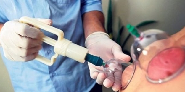 Hacamat tedavisi nasıl oluyor?