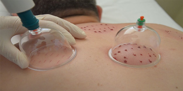 Hacamatın faydaları nelerdir?