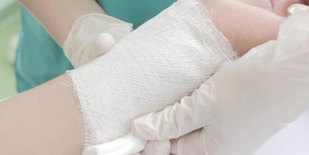 Hafif yanık tedavisi nasıl olmalı?