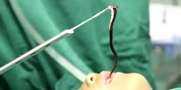 Hala canlı! 5 yaşındaki çocuğun boğazından çıkarıldı