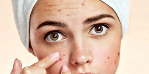 Halk arasında az biliniyor Geçmek bilmeyen sivilceniz varsa dikkat