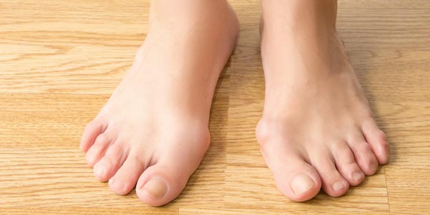 Halluks valgus ameliyatı nedir nasıl yapılır?