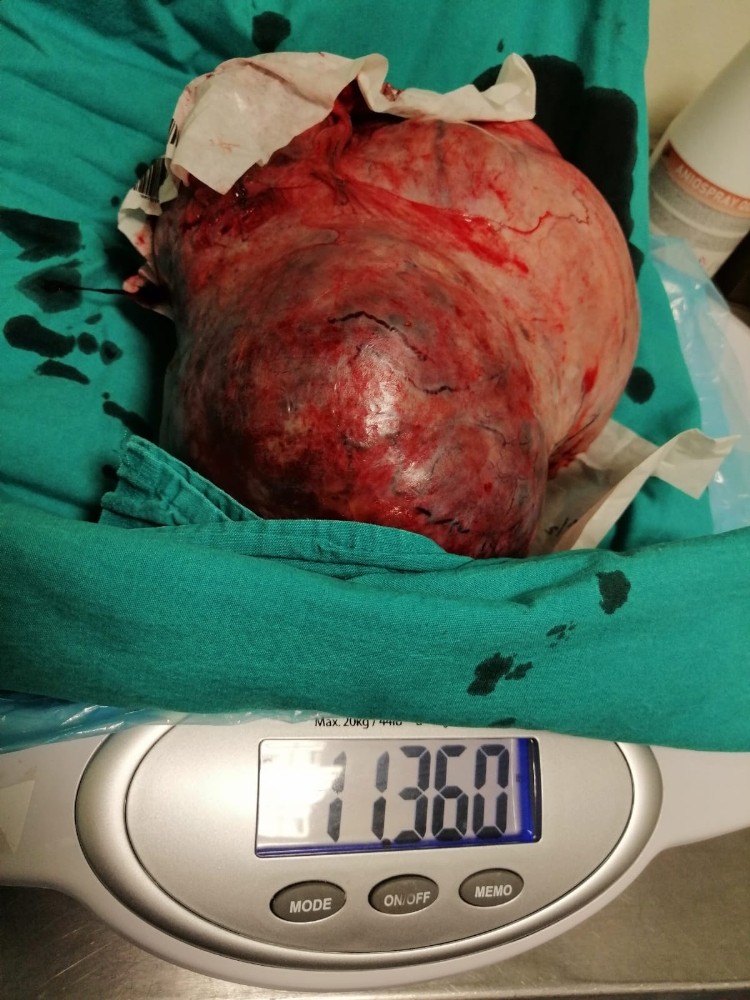 Hamile sanılan kadının karnından 11 kilo ur çıktı 